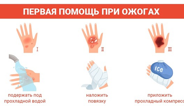 Термический ожог? Правила действий.